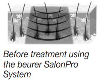 beurer_hair_removal_ipl_10000-what_is_the_beurer_salonpro_system.png